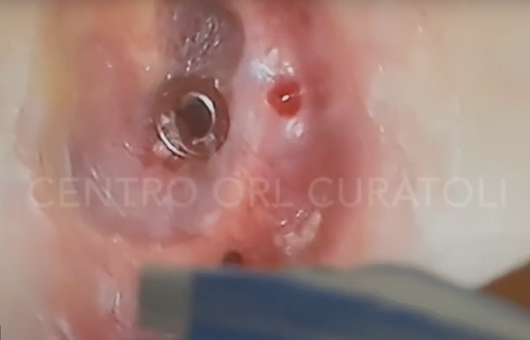 Drenaggio trans-timpanico in endoscopia