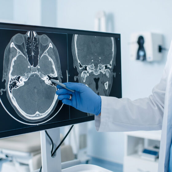 TAC dell'orecchio per la diagnosi e lo studio dell'estensione del colesteatoma