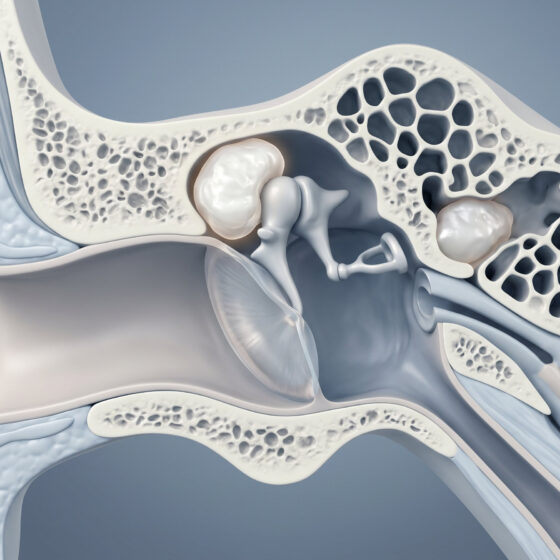 Colesteatoma nell'orecchio medio, dietro il timpano, vicino agli ossicini e alla mastoide