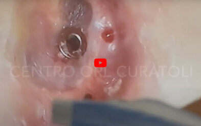 Drenaggio trans-timpanico: come avviene in endoscopia
