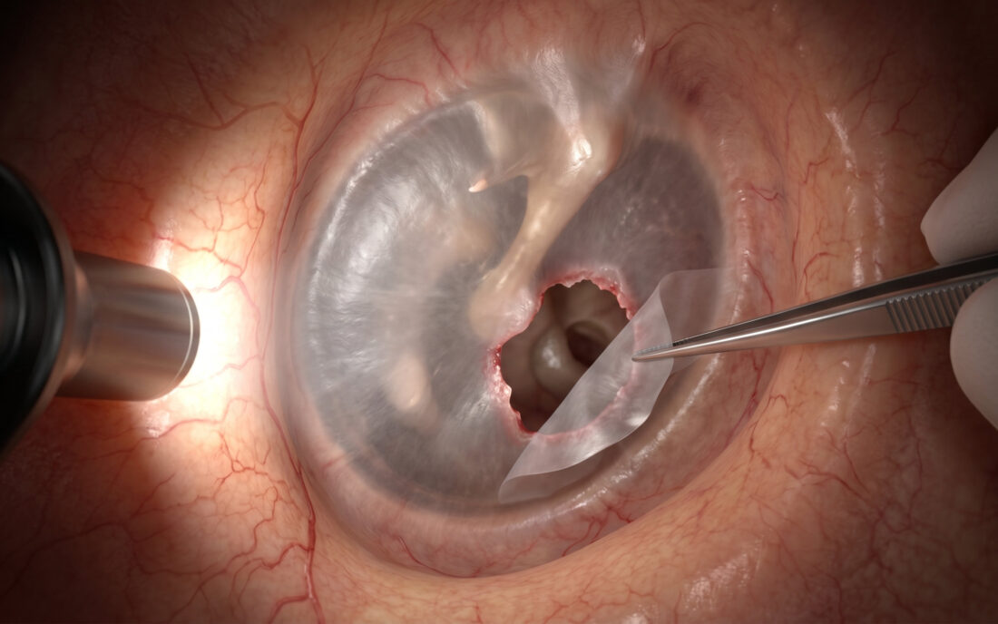 Miringoplastica endoscopica: il Centro ORL Curatoli organizza il Congresso Nazionale SIO