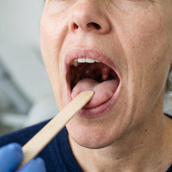 Noduli, polipi ed edema di Reinke: le lesioni benigne delle corde vocali