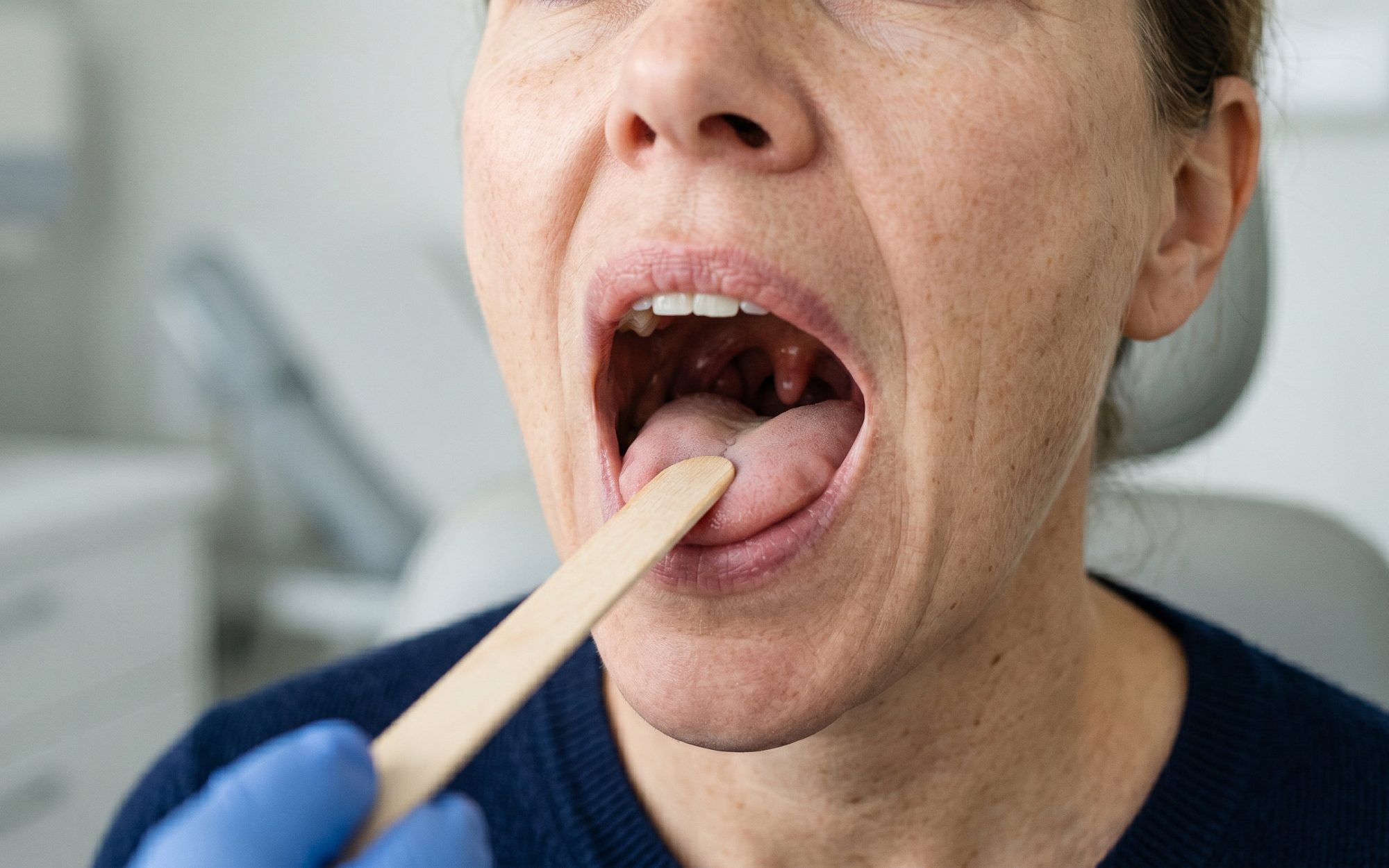 Esame della gola a bocca aperta per la diagnosi di noduli, polipi ed edema di Reinke alle corde vocali