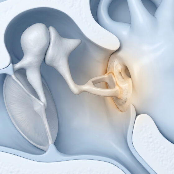 Otosclerosi, blocco della staffa tra gli ossicini dell'orecchio medio