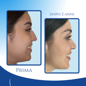 Punta stabile anche al sorriso — La punta mantiene la sua proiezione alta senza scendere durante il sorriso, valorizzando l’armonia del profilo e la naturalezza delle espressioni.