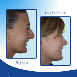 Stabilità della punta nel sorriso — Dopo l’intervento, la punta mantiene la sua proiezione alta anche durante il sorriso, evitando la discesa tipica del pre operatorio e garantendo naturalezza in ogni espressione.