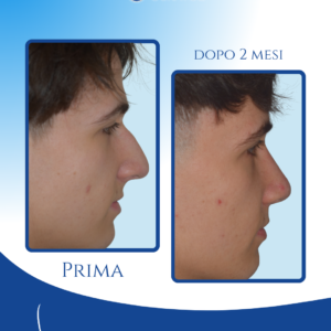 Profilo più lineare e naturale — La rinoplastica preservation ha corretto il gibbo, ottenendo un profilo più armonico senza alterare i lineamenti.