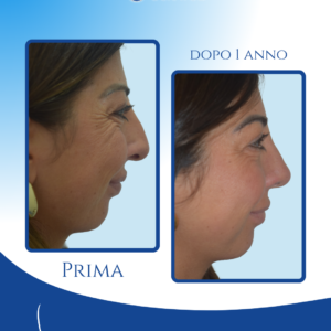 Profilo più regolare e definito — Il dorso appare più lineare e la punta più alta ed equilibrata, con un miglioramento estetico che si integra perfettamente con i lineamenti del viso.