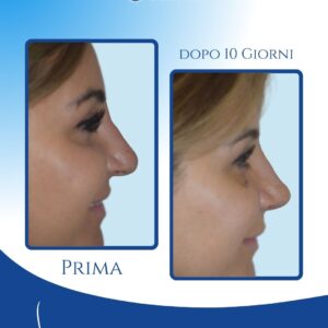 Risultato naturale già nei primi giorni — A soli 10 giorni dall’intervento, la punta risulta stabile e snellita anche durante il sorriso, con un profilo più armonico e un aspetto già sorprendentemente naturale.
