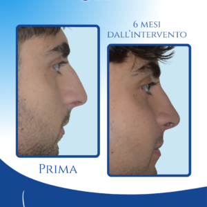 Confronto a distanza di 6 mesi: la punta mantiene un’elevazione armoniosa e il gibbo è eliminato, evidenziando la stabilità del risultato ottenuto con tecnica di preservation.