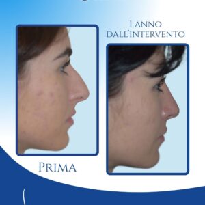 Profilo più armonico e naturale — A un anno dall’intervento, dopo l’eliminazione del gibbo, il profilo risulta più regolare e proporzionato, con un miglioramento naturale che valorizza i lineamenti senza alterarli.v