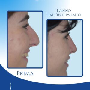 Punta stabile anche al sorriso — Durante il sorriso la punta mantiene la sua posizione alta senza scendere, garantendo un’espressione più armoniosa e naturale.