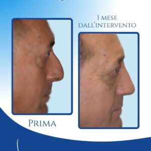 Profilo più definito e naturale — La rinosettoplastica preservation ha migliorato la linea dorsale, mediante l’eliminazione del gibbo e l’armonia del profilo, mantenendo un aspetto maturo e naturale senza alterare l’identità del volto.