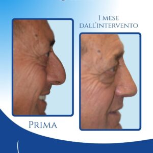 Punta stabile durante il sorriso — L’intervento ha eliminato l’effetto antiestetico che il sorriso provocava sul naso e sull’espressione, restituendo una punta stabile e un sorriso più equilibrato e gradevole.