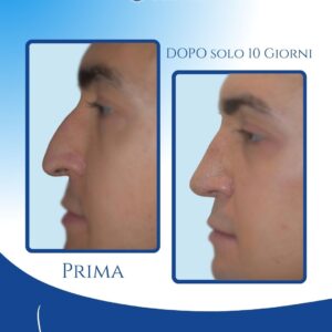 Profilo più armonico e regolare — La rinosettoplastica preservation ha corretto le irregolarità del dorso, eliminato il gibbo e migliorato l’armonia del profilo, donando un risultato naturale e proporzionato.