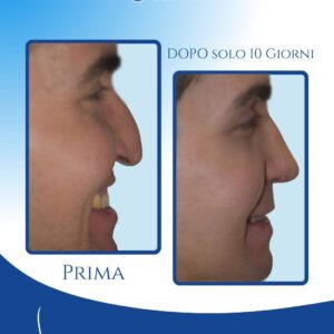 Correzione perfetta dell’effetto sorriso — L’intervento ha eliminato l’effetto antiestetico che il sorriso provocava sul naso e sul viso, restituendo una punta alta stabile e un’espressione molto più equilibrata e piacevole.