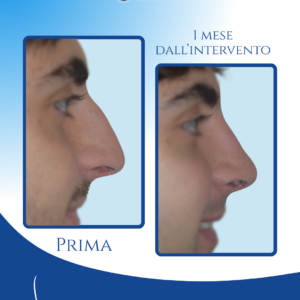 Naso maschile con gibbo naturale — Un piccolo gibbo residuo sul profilo è spesso richiesto dai pazienti di sesso maschile per mantenere un aspetto naturale e coerente con l’estetica del volto.