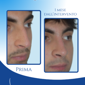 Profilo armonioso e punta ruotata — Nel risultato post operatorio il profilo appare più armonioso, con una naturale rotazione verso l’alto della punta che valorizza l’estetica maschile mantenendo un aspetto autentico.