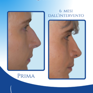 Profilo maschile più equilibrato — La rinosettoplastica preservation ha corretto le irregolarità del dorso e migliorato l’armonia del profilo mantenendo un aspetto naturale e coerente con l’estetica maschile.