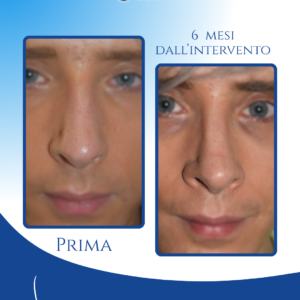 Simmetria e naturalezza frontale — A sei mesi dall’intervento il naso appare più dritto e proporzionato, con una migliore simmetria frontale che valorizza l’intero volto.