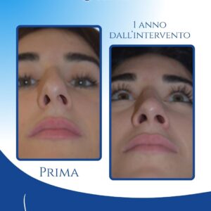 Correzione completa della deviazione — L’inquadratura dal basso mostra chiaramente quanto il setto fosse deviato prima dell’intervento; la rinosettoplastica preservation ha restituito una base più simmetrica e un allineamento stabile nel tempo.